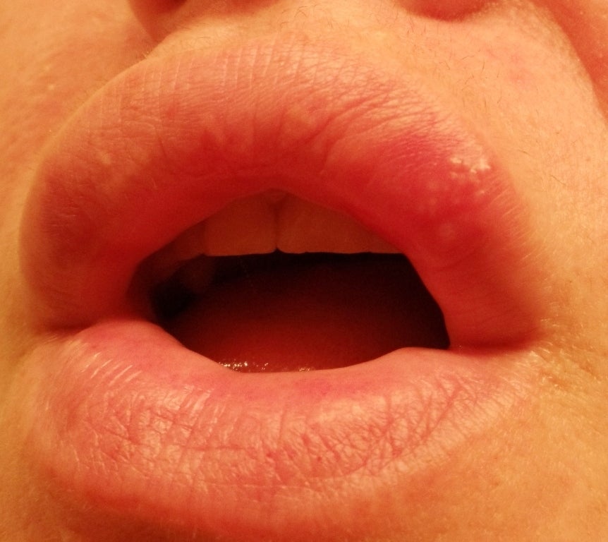 White Bumps on Lips, Inside Lower Lip, Pictures, Small ...