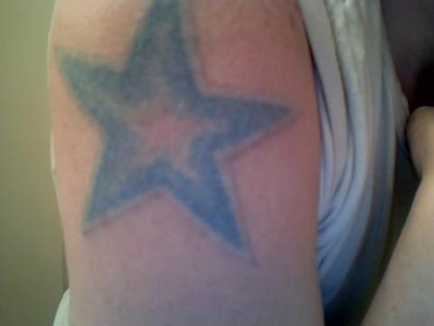 Tattoo Removal Not Working. How Do I Find Best Provider for Excision or 