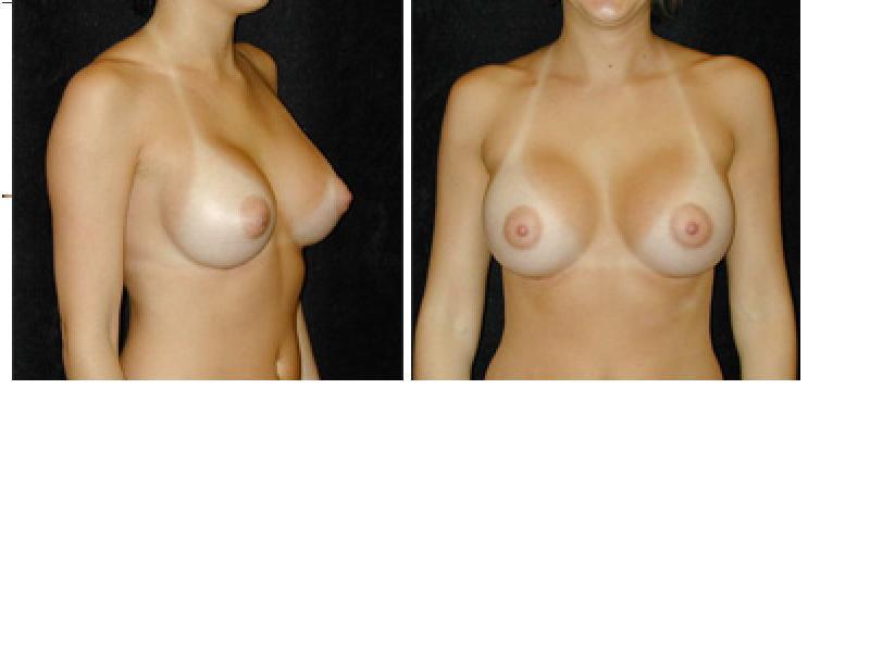 6 answers to Conical Implant Will This Make my Breasts Look Pointy