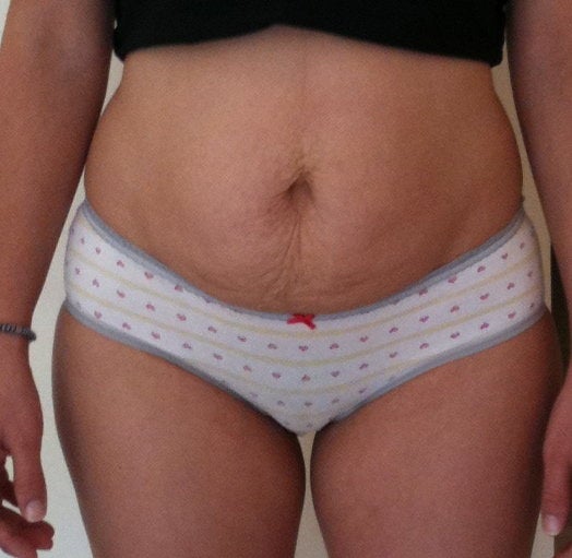 separated stomach muscles. Can a Tummy Tuck Correct