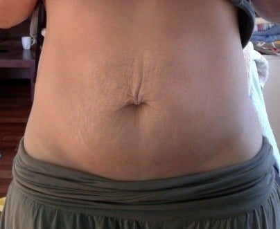 bellies with stretch marks. skin and stretch marks-