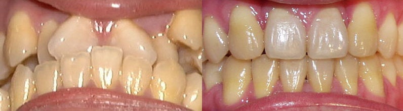 Before And After Braces. Full size - efore and after