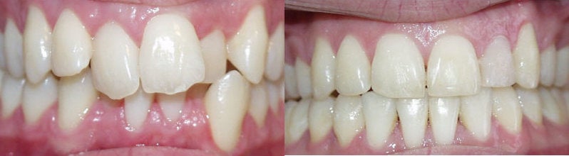 braces before and after braces photos. Braces: Before and after