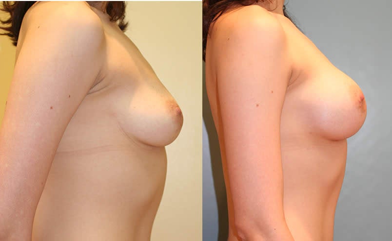 breast augmentation before and after c cup. Full size - Before and After