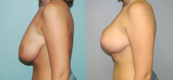 breast lift without implants. Full size - Breast Lift
