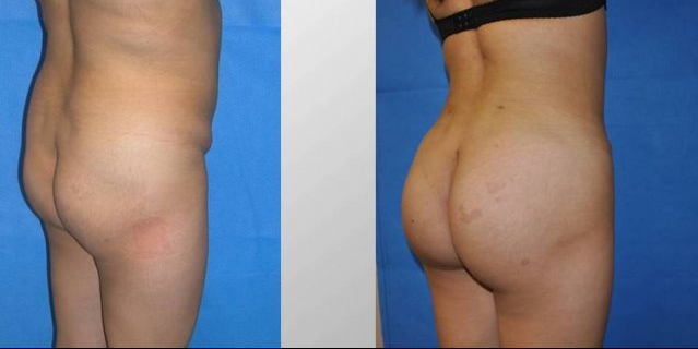 buttock implants before and after. Full size - Before and After