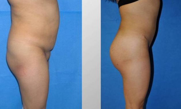 buttock implants before and after. Full size - Before and After