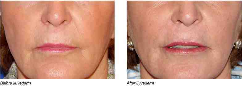 Over 1.2 million injections of hyaluronic acid fillers were given last year.