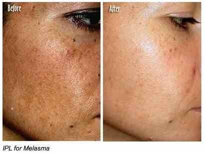 Hydroquinone Before and After
