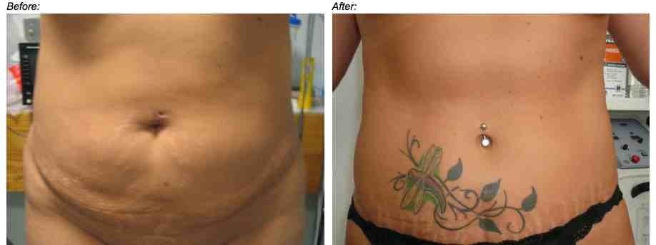 Liposuction is NOT a technique for removing stretch marks. Laser stretch 