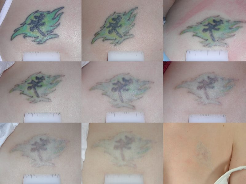 tattoo removal before and after. Tattoo Removal