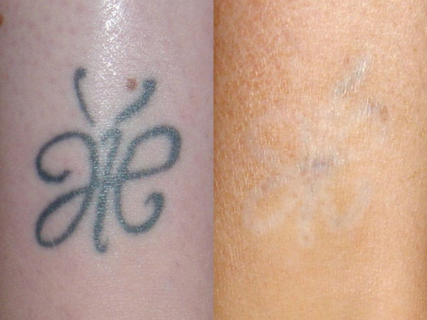 tattoo removal before and after. efore after.