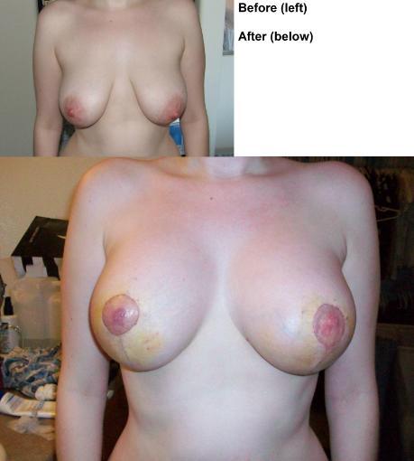 39 answers to Uneven Nipples After Breast Augmentation and Lift