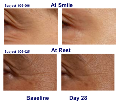 Topical Botulinum Toxin A Cream made by Revance before and after results
