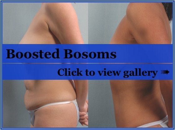 breast lift pictures. Interest in reast lift