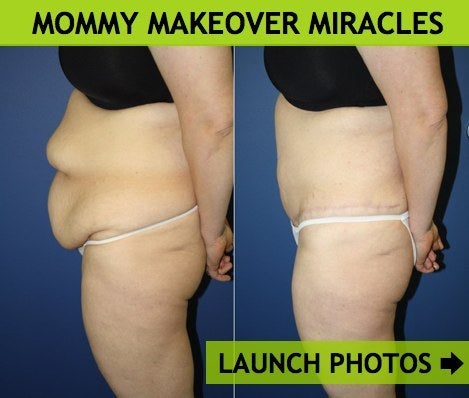 Makeover Before After. Mommy makeover before and