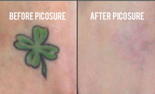 Laser Removalin Tattoo Pictures to Pin on Pinterest