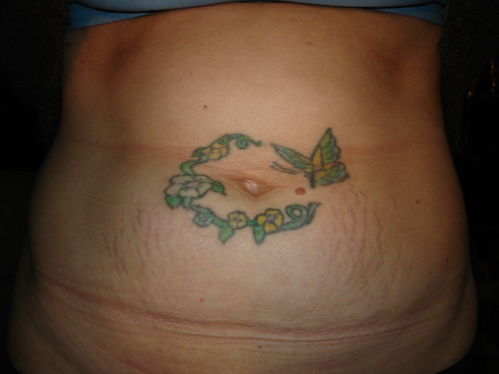 laser tattoo removal ,tattoo