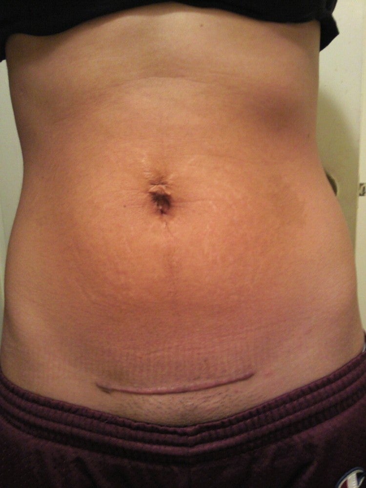 Mini Tummy Tuck for Stretch Marks and Piercing Scar?