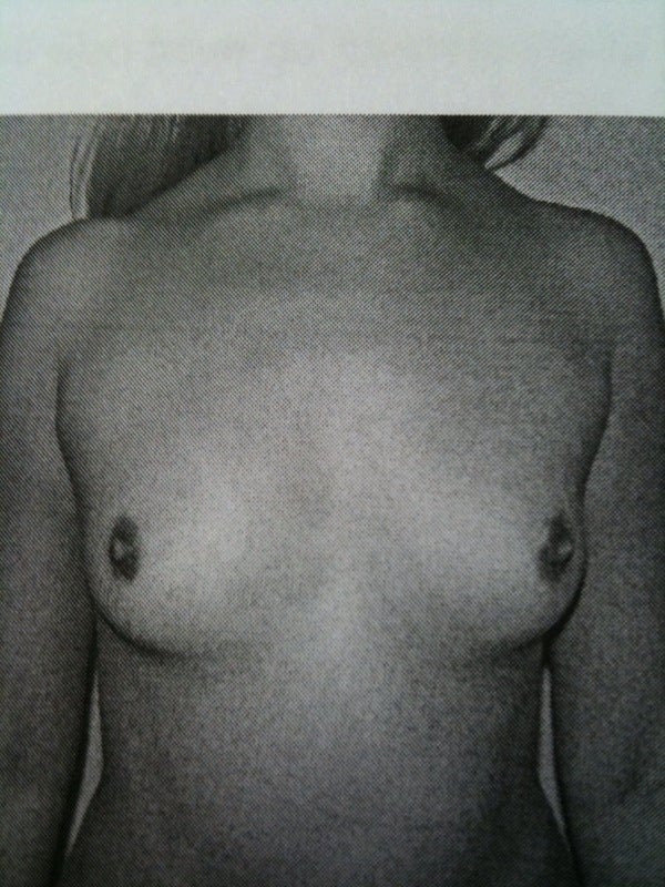 breast augmentation before and after c cup. Before or After: