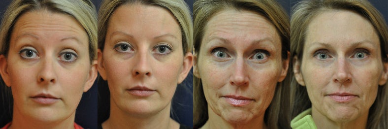 Botox and dermal fillers injections in ...