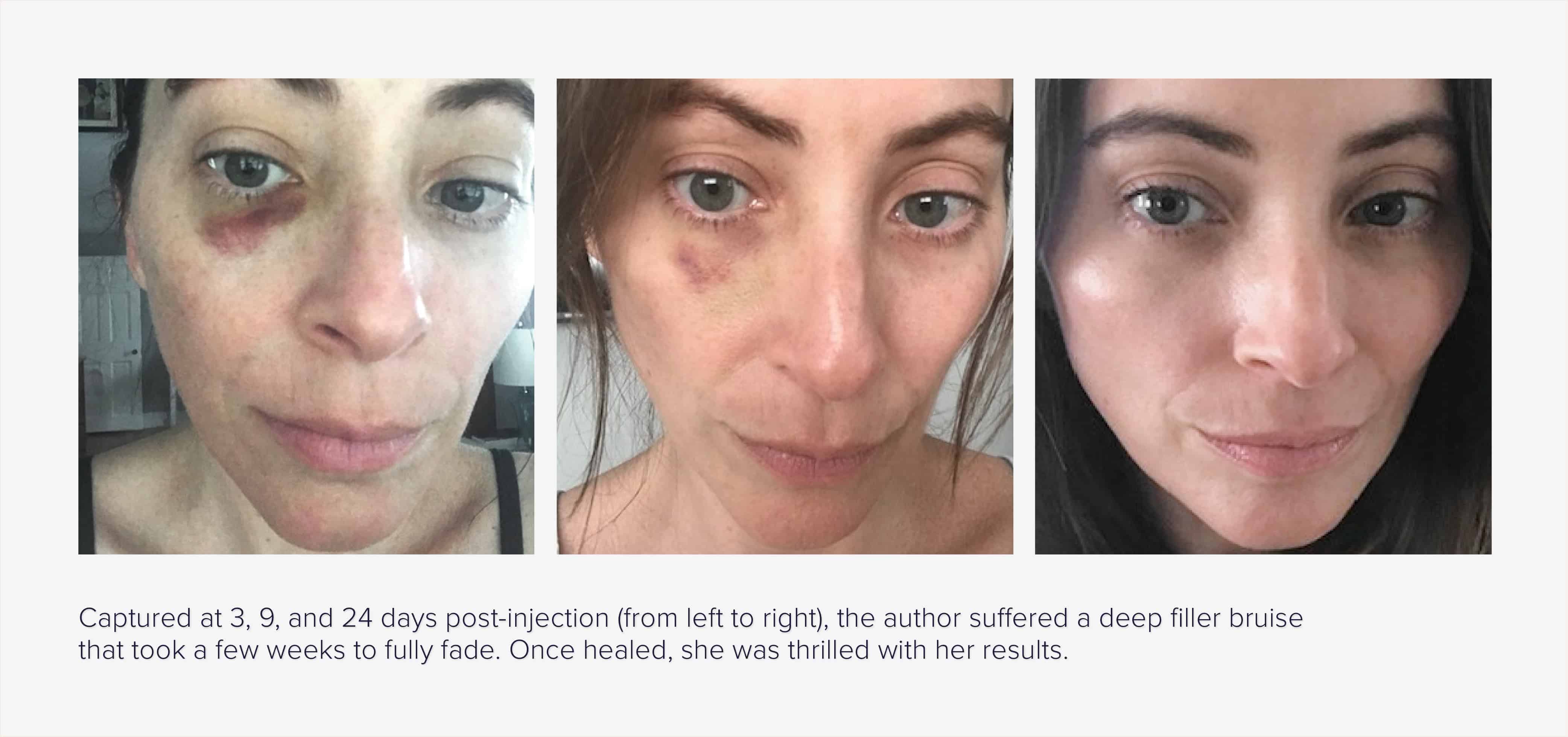 Progression of bruising after injectable fillers