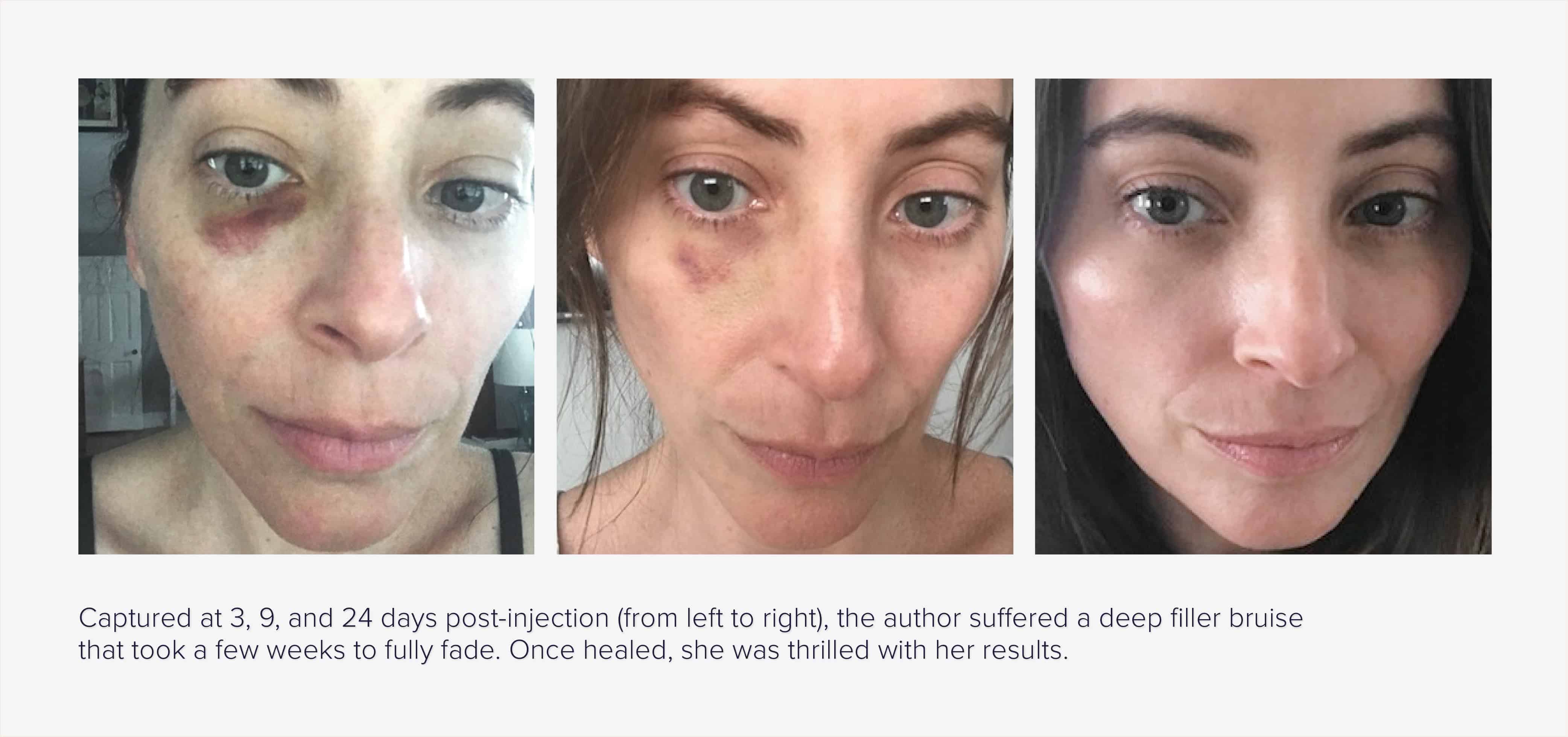 How To Minimize Bruising After Lip Injections Infoupdate
