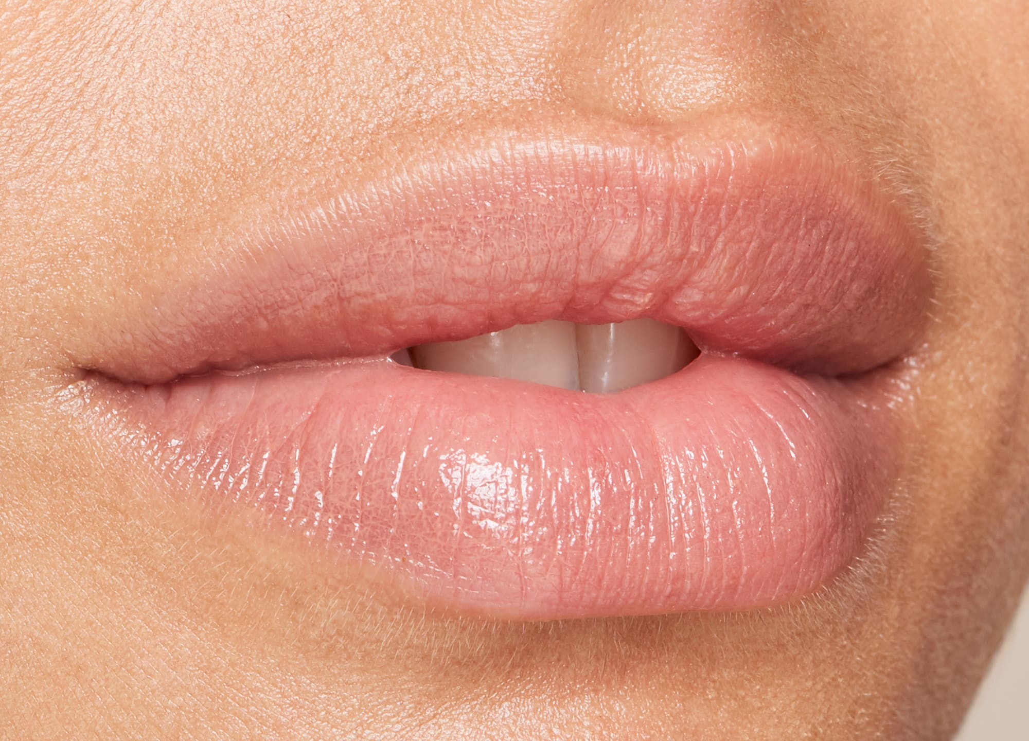 Dermal filler for Cupid's bow - Cosmetic Connection