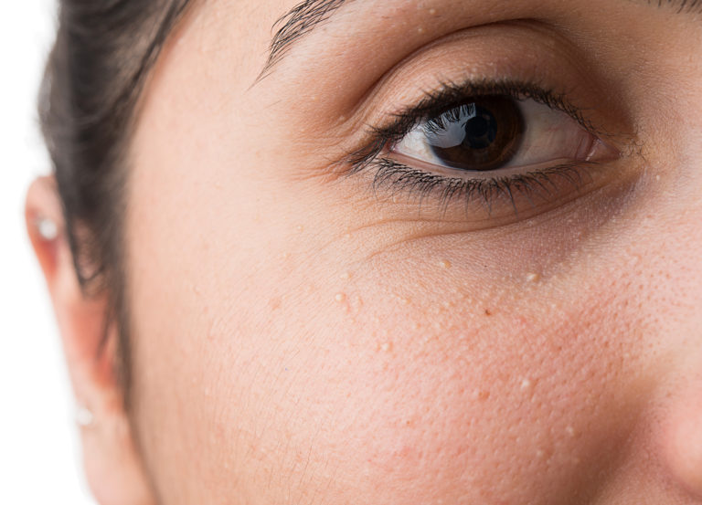 Three skin experts give us tips on how to prevent and get rid of milia under the eyes (or milk spots), with both at-home remedies and in-office treatments.