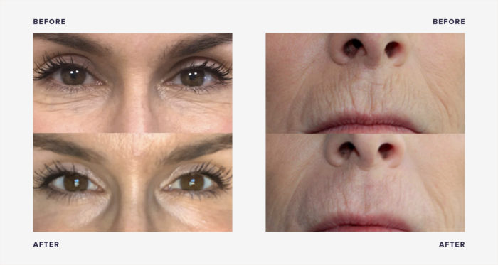 Plasma Pen before and after photos for wrinkles and lip lines