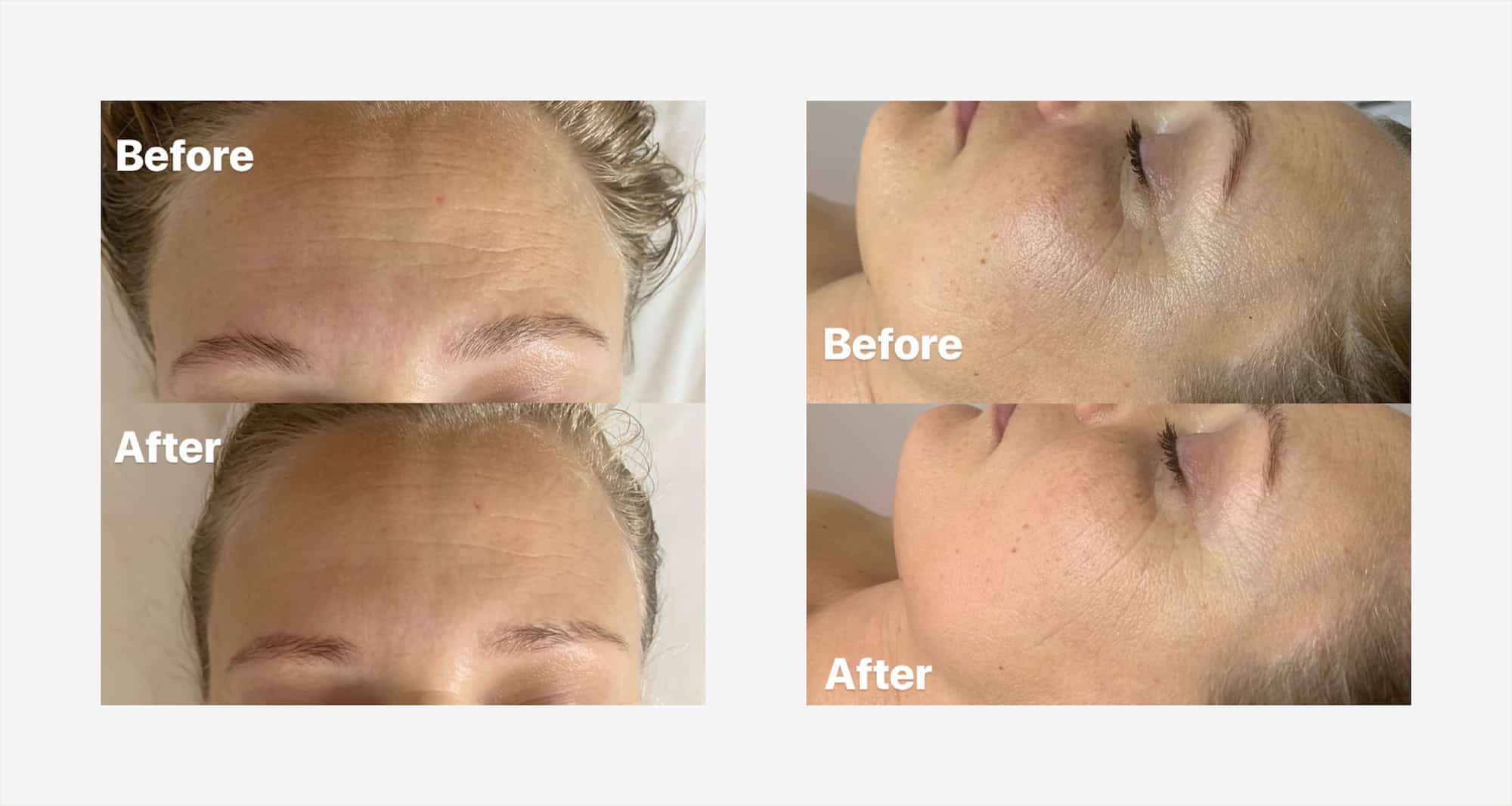 Facial Massage and Jade Rollers Do They Actually Work? RealSelf News