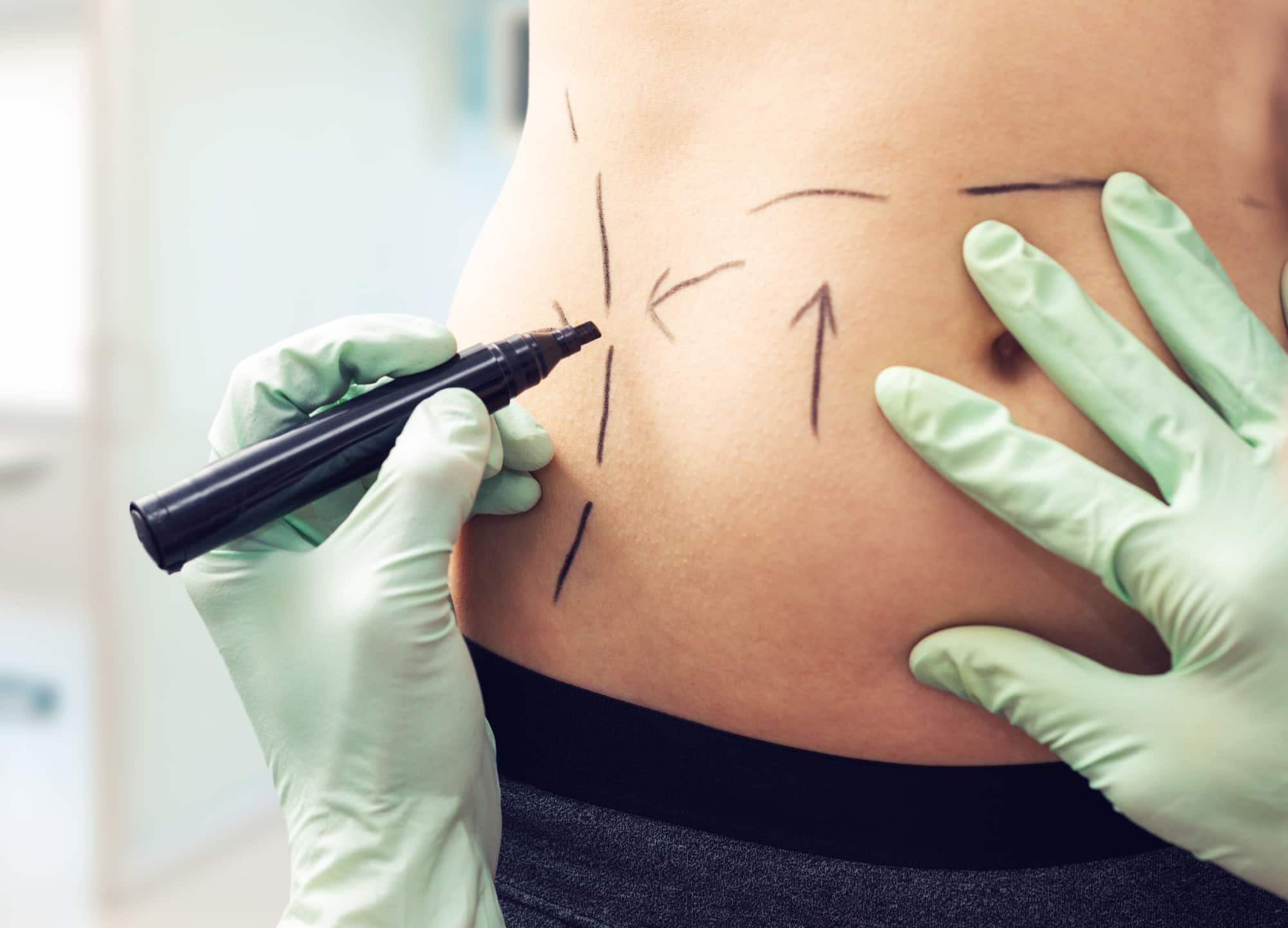 Liposuction vs. Tummy Tuck