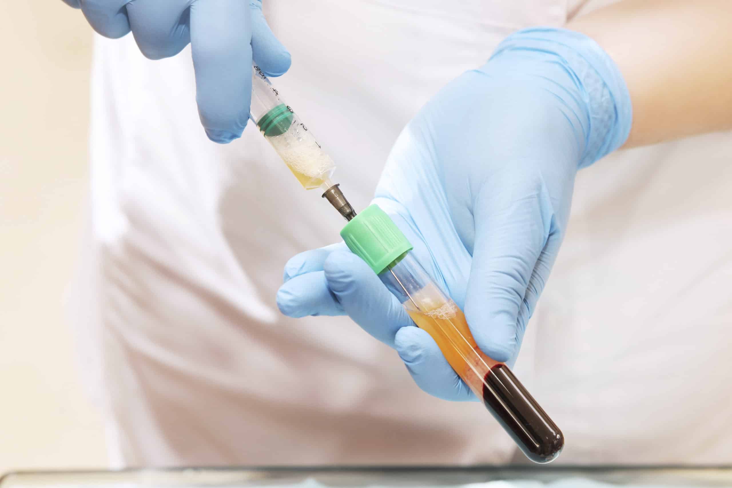 PRP is a treatment for hair loss, wound healing, scars, skin rejuvenation, and sexual-health issues. Here are the PRP terms you need to know.