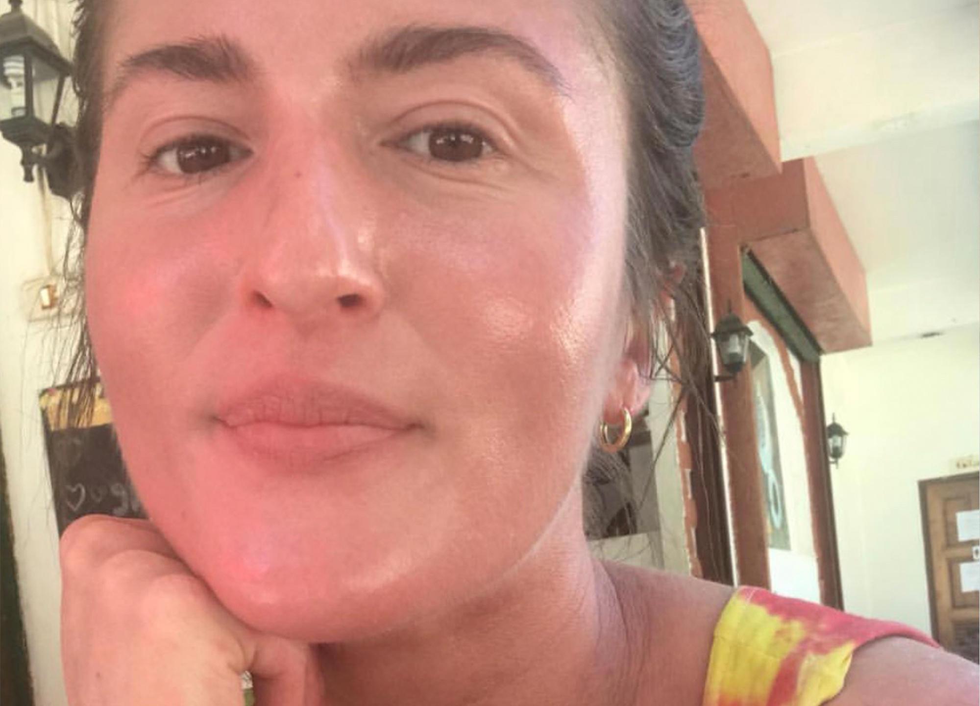 My condition, a rare form of ichythosis known as Netherton syndrome, is causing my skin to age at an accelerated rate. Here's how I'm dealing with it.