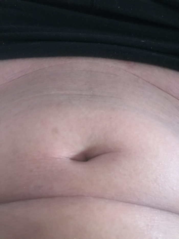 Netherton syndrome showing on the stomach