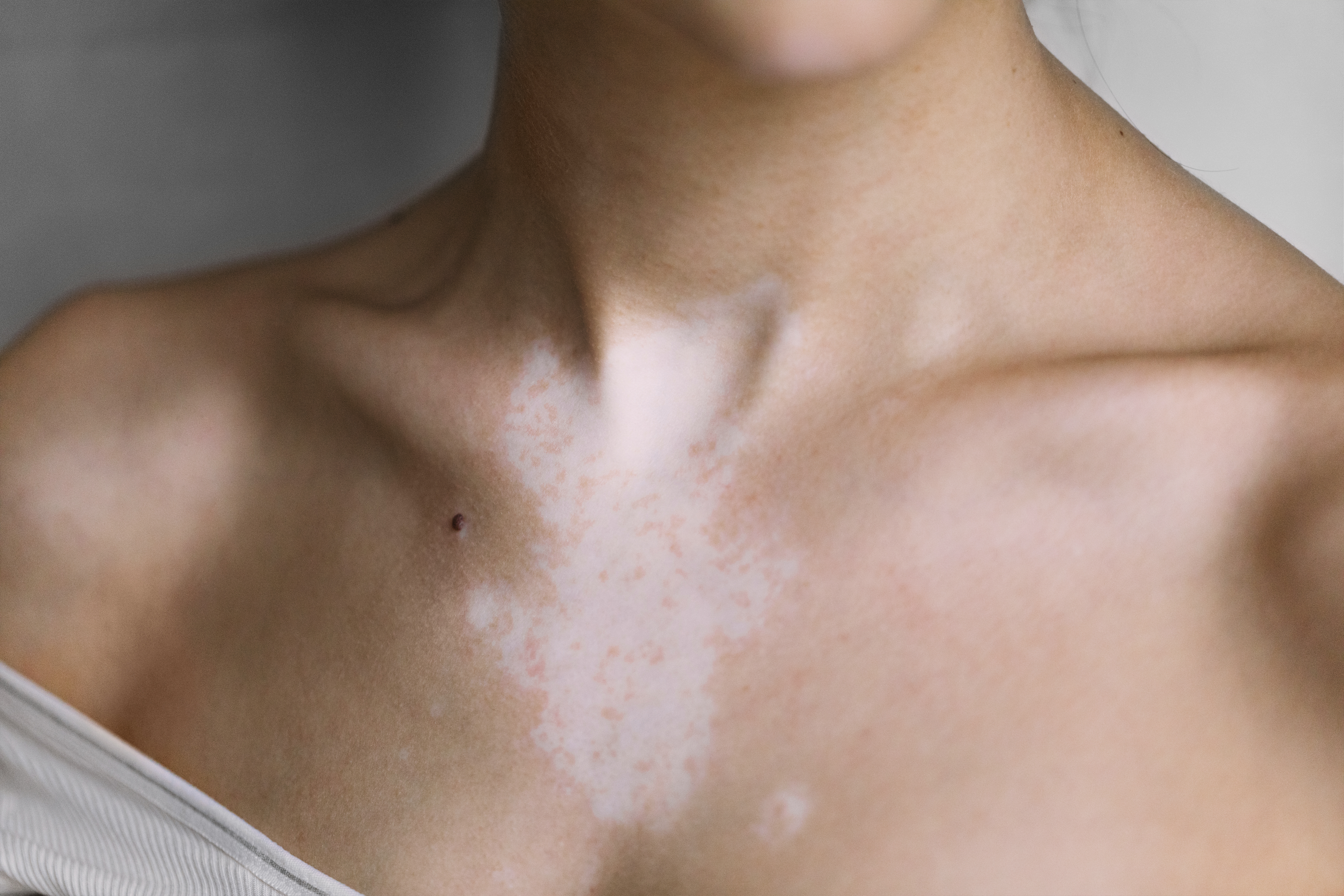 psoriasis hypopigmentation treatment