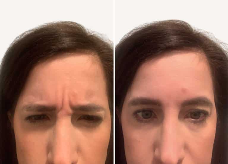 Curious about the difference between Jeuveau and Botox? One patient injected half her forehead with Jeuveau and the other half with Botox. See the results.
