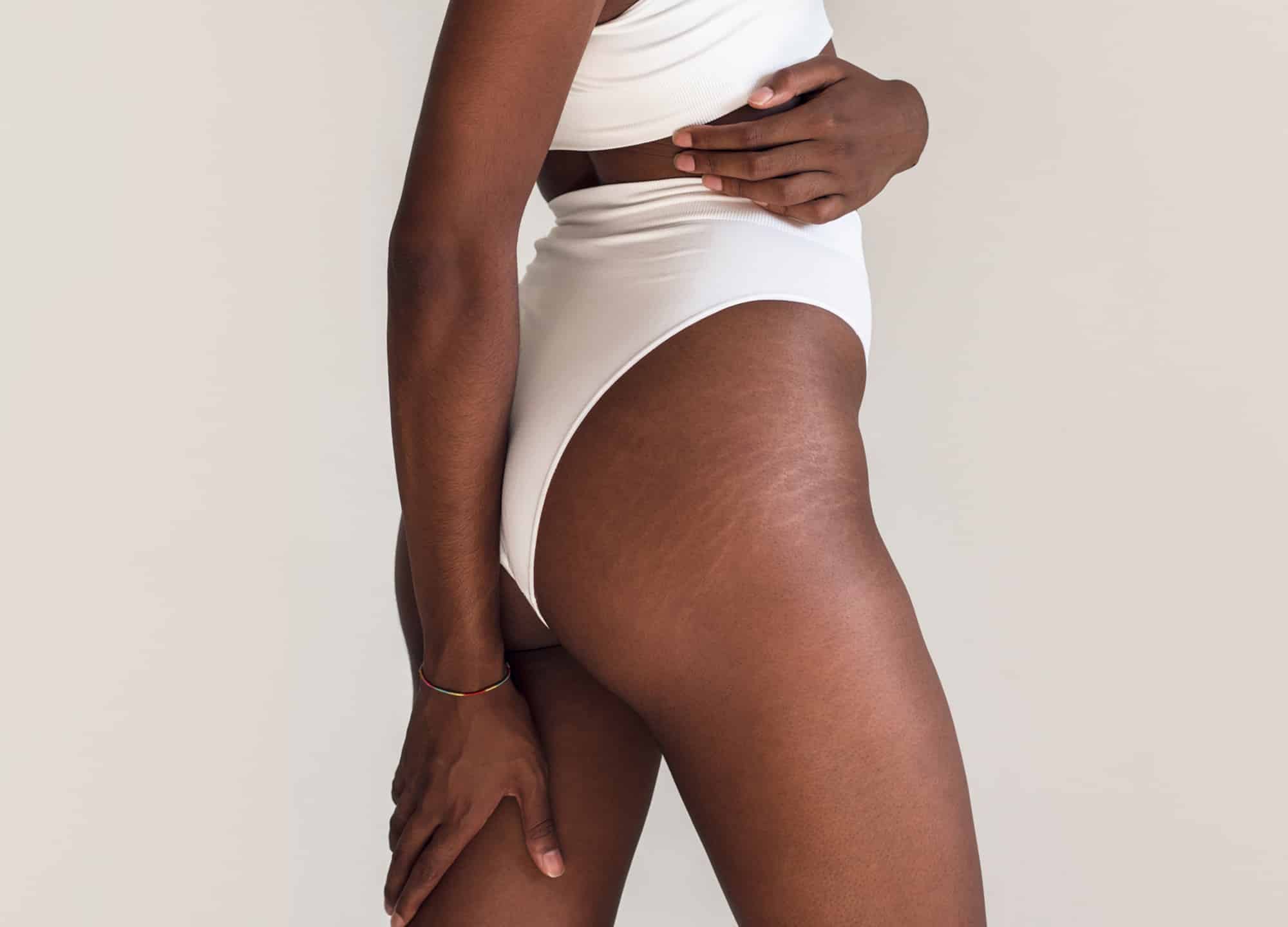 Stretch marks can be troublesome and difficult to treat, so we asked experts their go-to methods for stretch mark treatment.