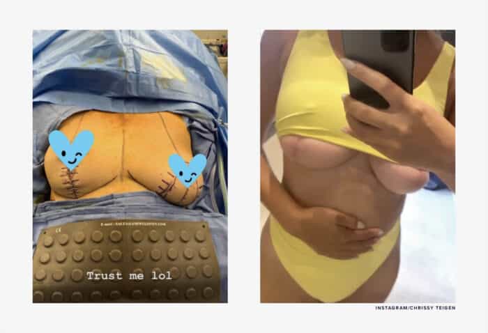Chrissy Teigen breast implant removal scars