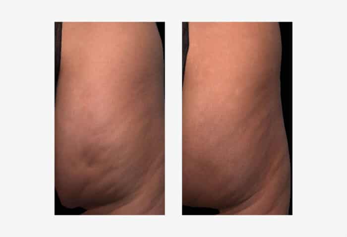 Qwo cellulite treatment before and after photo
