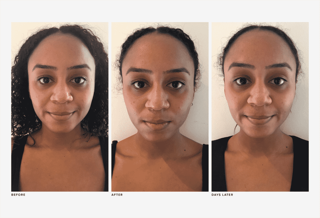 I’m a Black Woman Who Tried My First Laser Treatment RealSelf News