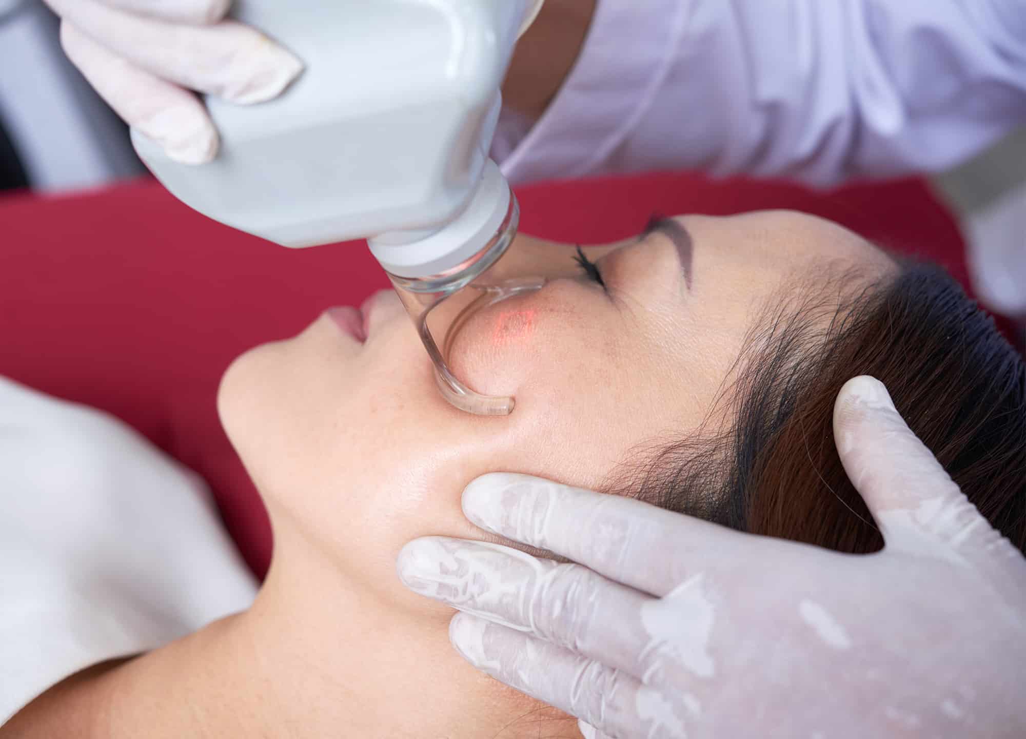 Acne scarring is treatable. Here are some of the most effective options, according to derms.