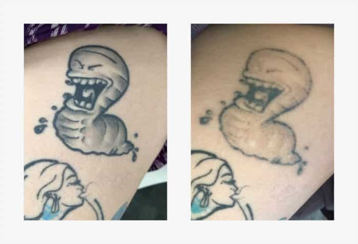 tattoo sleeve removal cost reddit