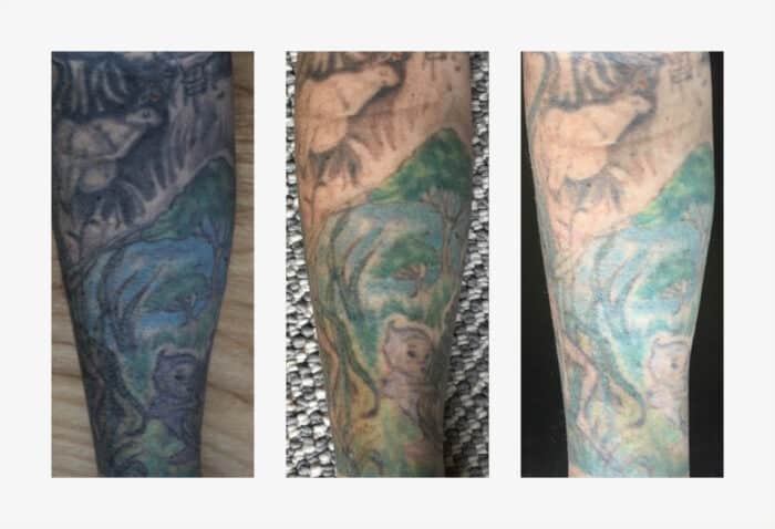 Tattoo removal with a Q-Switch laser, Evo Q Plus-C