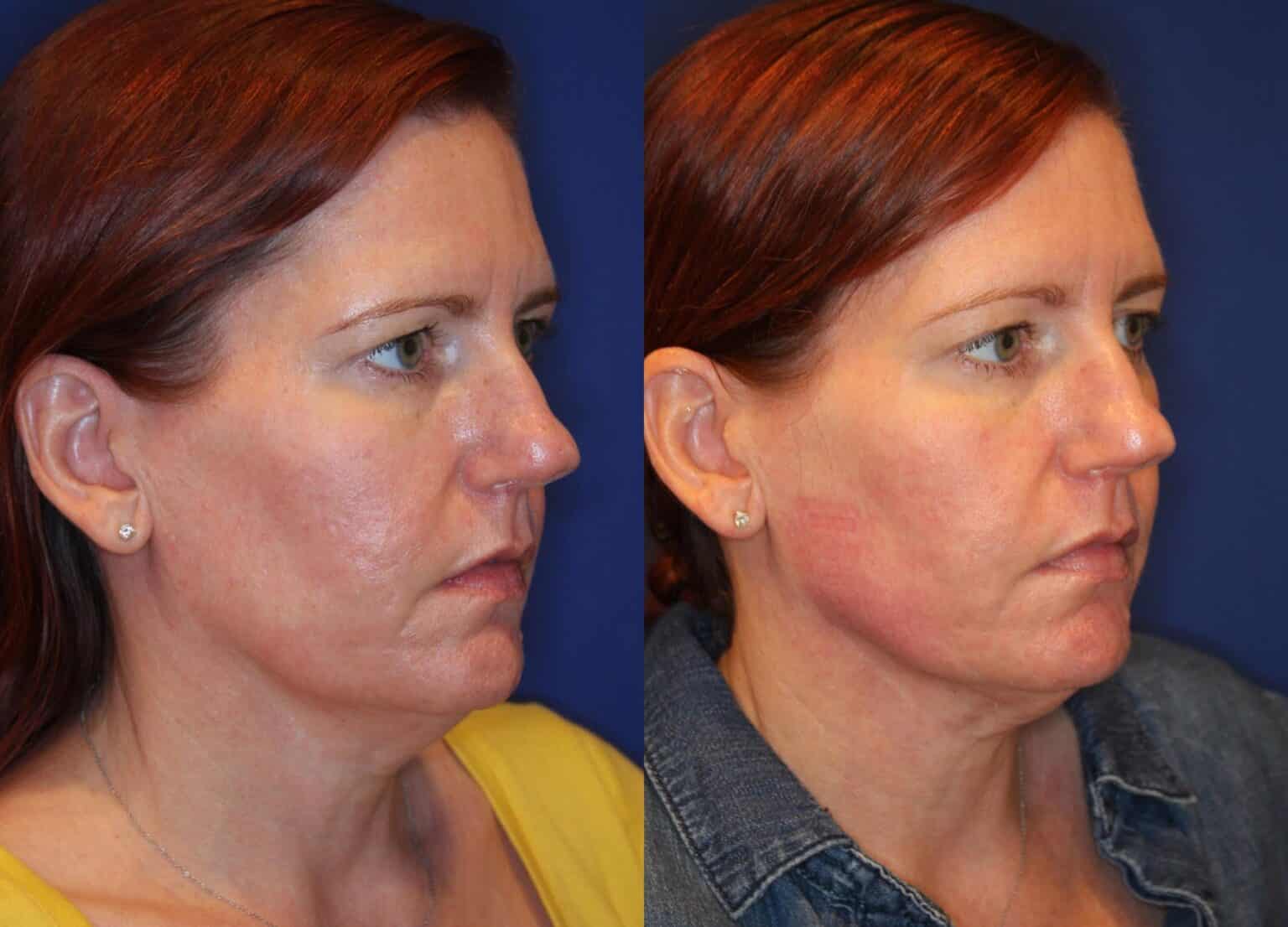 I Tried the New Evoke FaceTightening Treatment RealSelf News