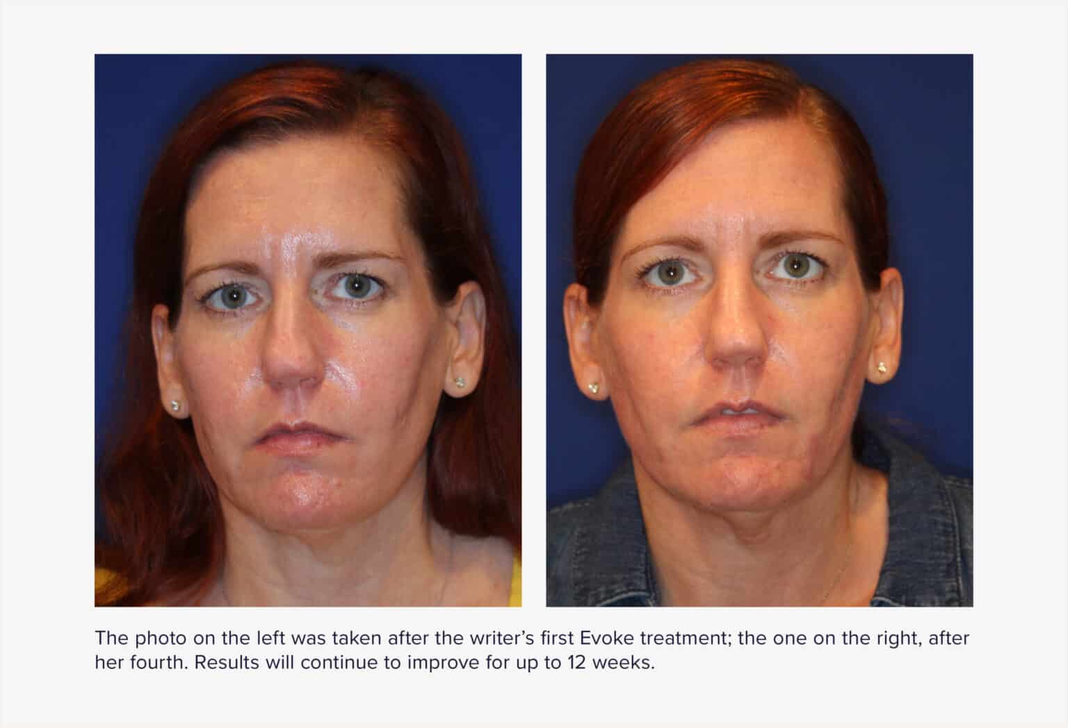 I Tried the New Evoke FaceTightening Treatment RealSelf News