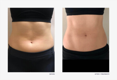 emsculpt unfiltered realself