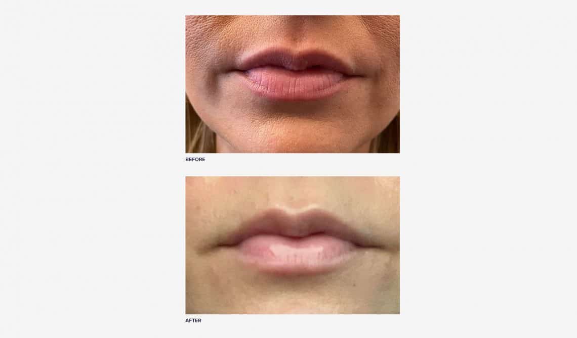 Botox Lip Flip vs. Lip Filler Pain Level & Results RealSelf News