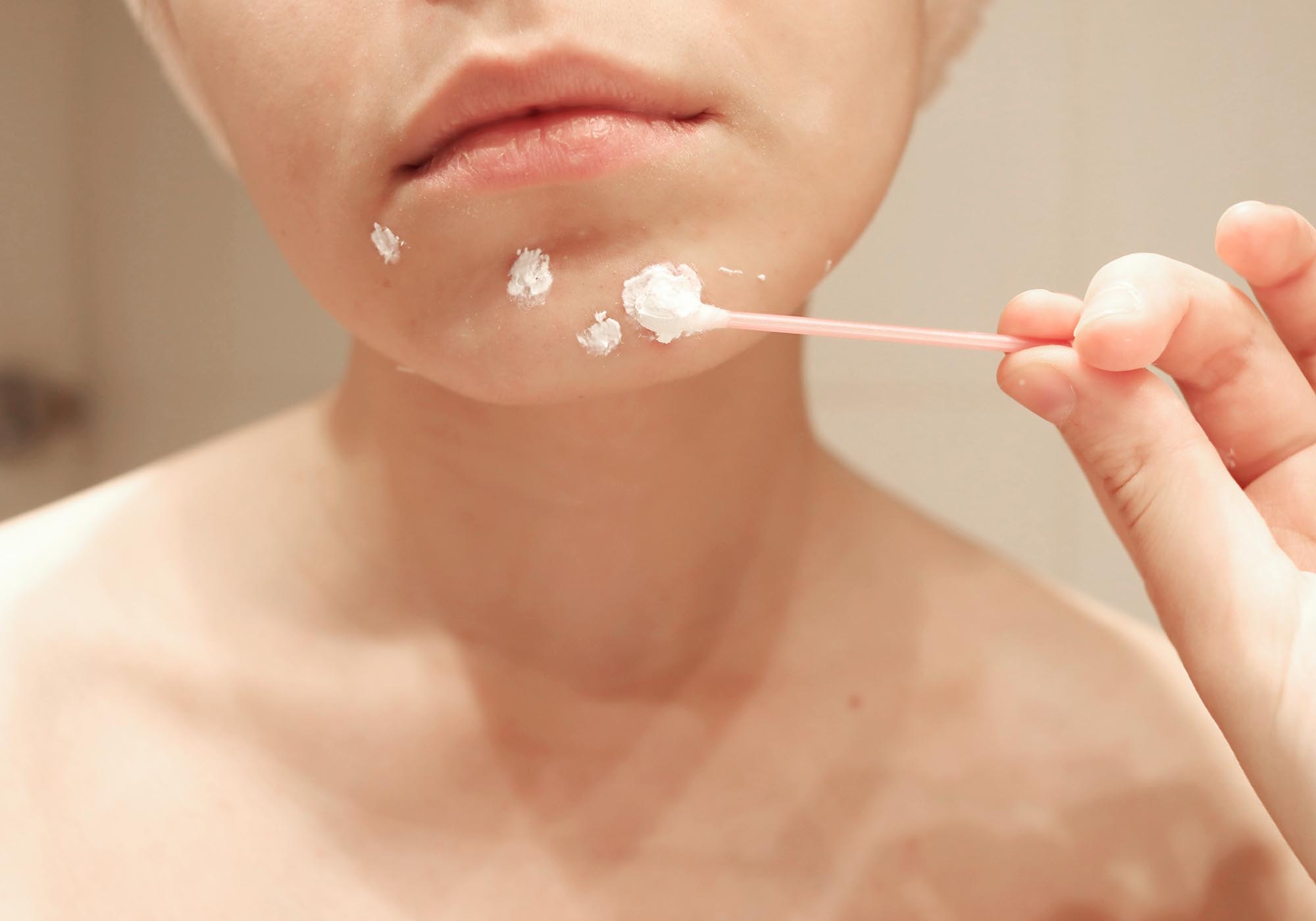 Twyneo is making big news as the first acne treatment to combine two of the most powerful of these ingredients—tretinoin and benzoyl peroxide.