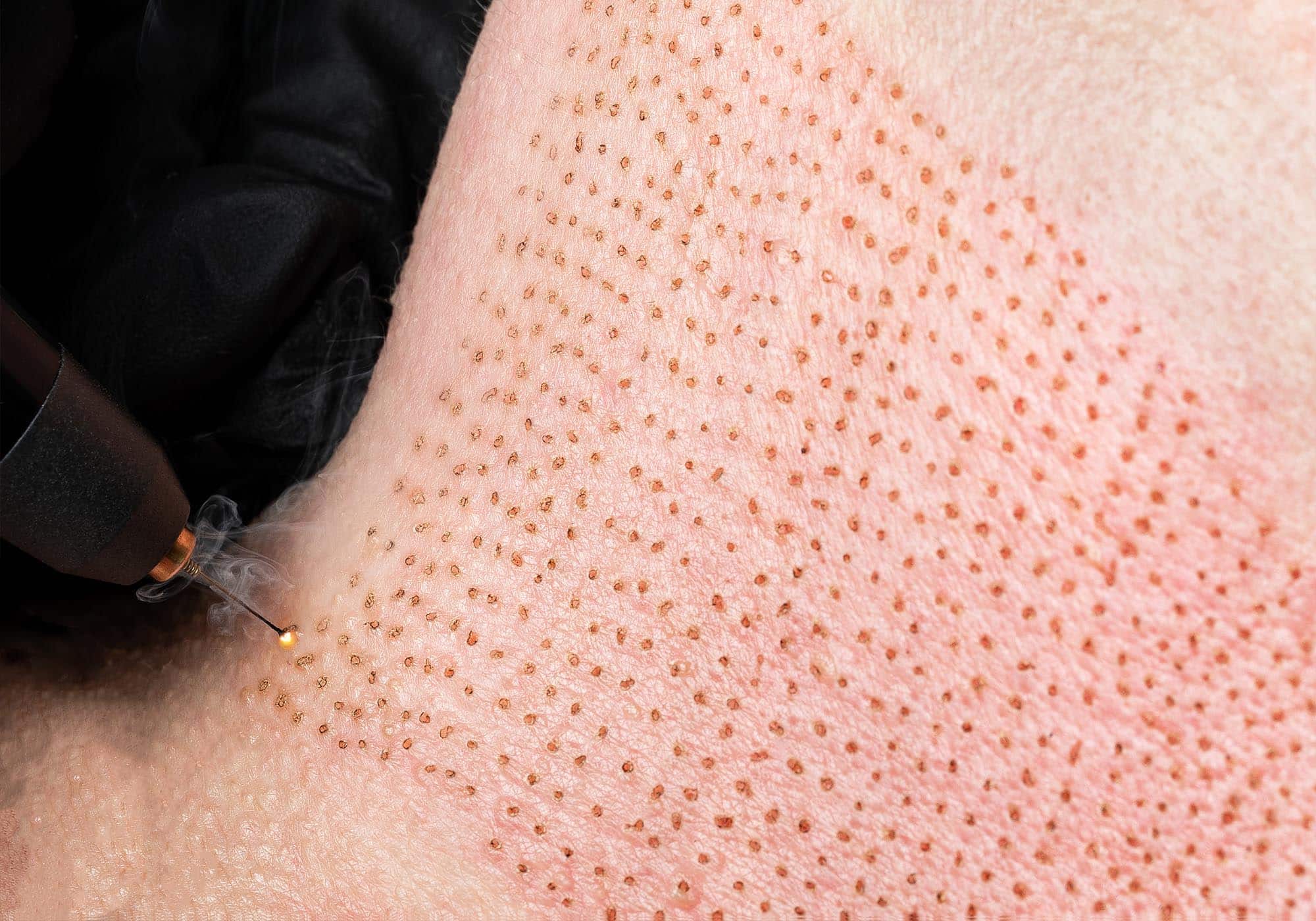 Experts explain what sets plasma fibroblasting treatments apart from its counterparts and why it may be something to consider.